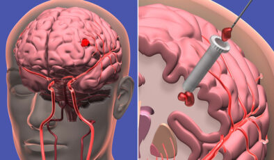 Beyin kanaması ile ilgili elzem bilgiler: Bulantı, kusma, şiddetli baş ağrısı varsa dikkat!