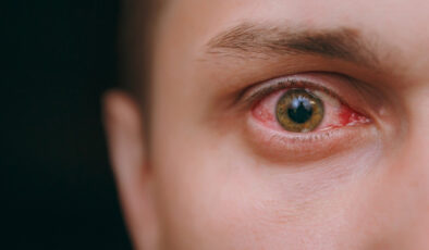 Covid’de gözdeki damar tıkanıklığı körlüğe sebep olabilir