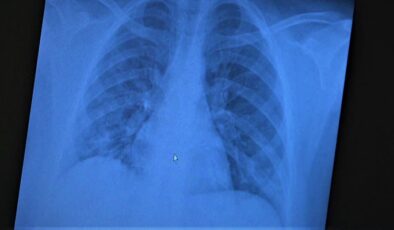 Akciğer tutulumu nedir, nasıl anlaşılır? İşte akciğer tutulumu belirtileri