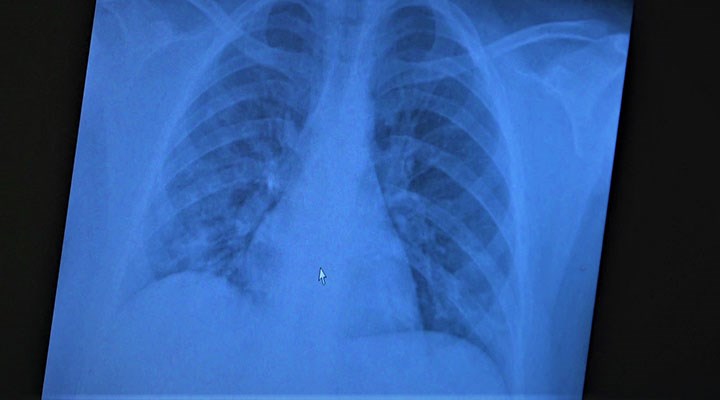 Akciğer tutulumu nedir, nasıl anlaşılır? İşte akciğer tutulumu belirtileri