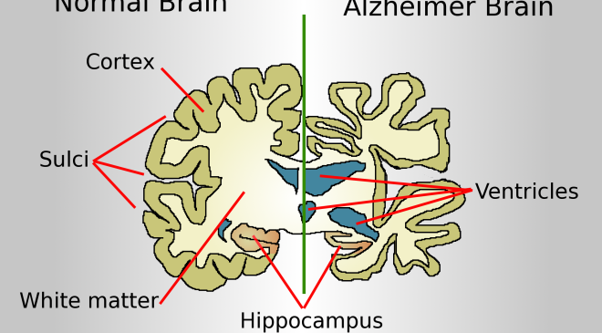 ALZHEİMER GERÇEĞİ…