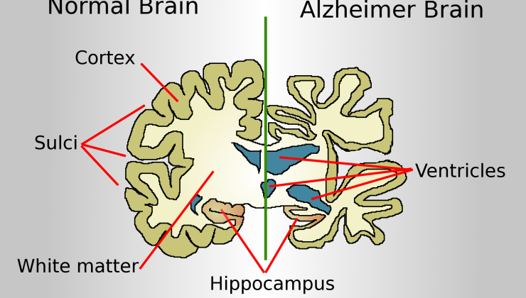 ALZHEİMER GERÇEĞİ…